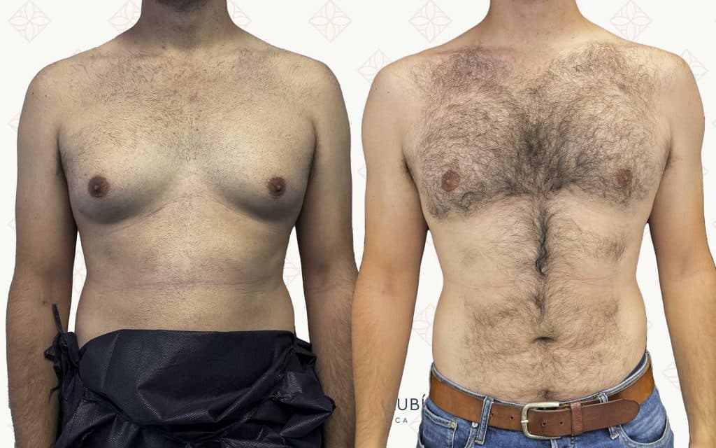 Resultado antes y después de ginecomastia — caso 2