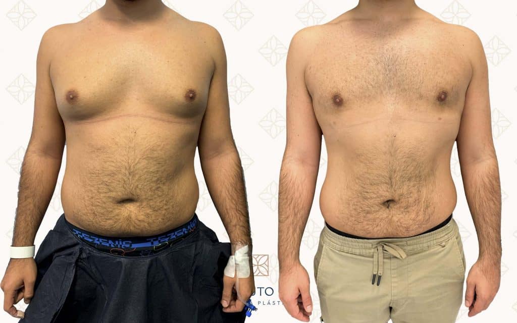 Resultado antes y después de ginecomastia — caso 1