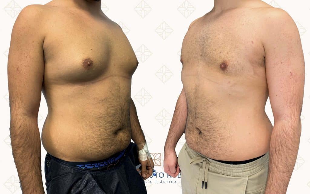 Resultado antes y después de ginecomastia — caso 3