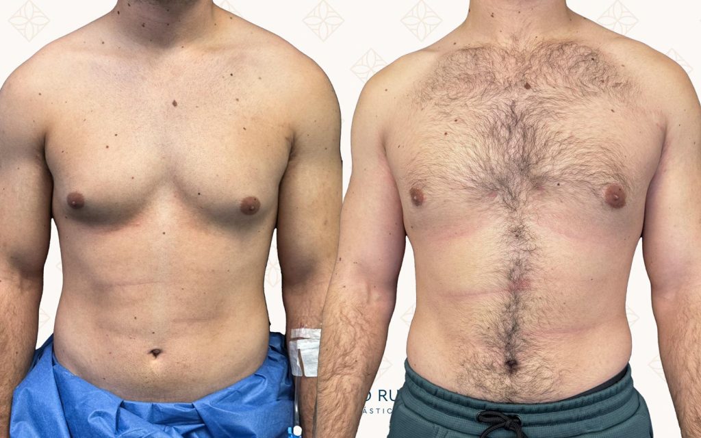 Resultado antes y después de ginecomastia — caso 7