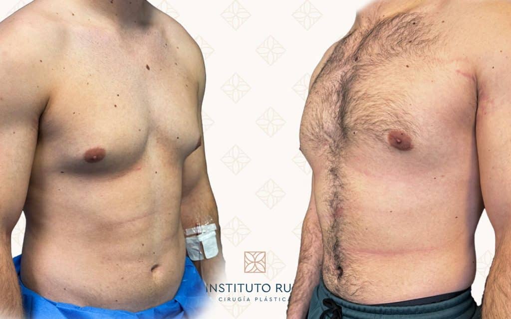 Resultado antes y después de ginecomastia — caso 8