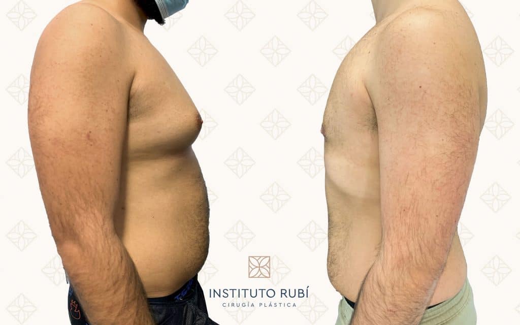 Resultado antes y después de ginecomastia — caso 5