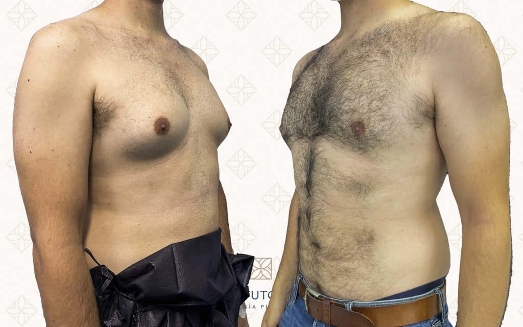 Resultado antes y después de ginecomastia — caso 4