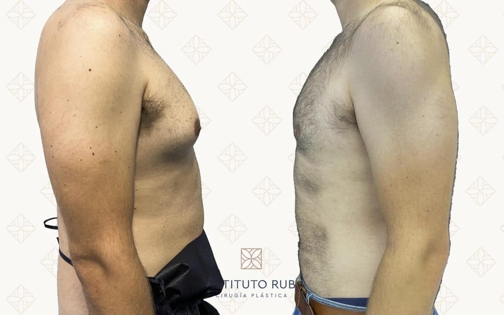 Resultado antes y después de ginecomastia — caso 6